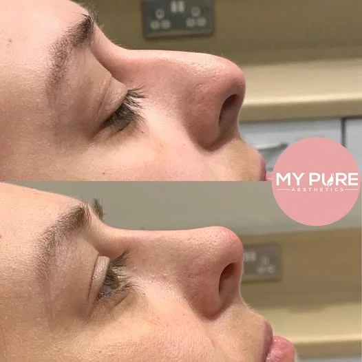 Precision, Balance, Confidence: The Growing Demand for Liquid Rhinoplasty London