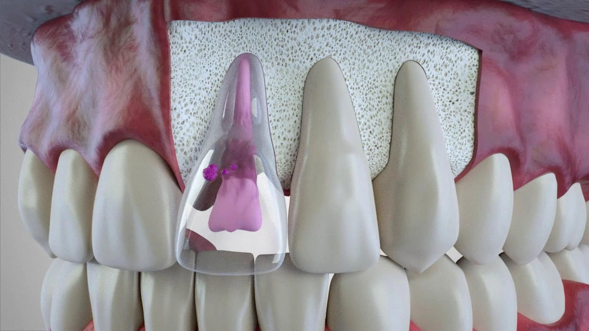 Signs and Diagnosis of Dental Internal Resorption