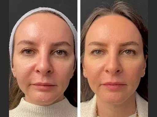 Best Aesthetic Clinics in Dubai Offering Expert Mesotherapy Treatment Services