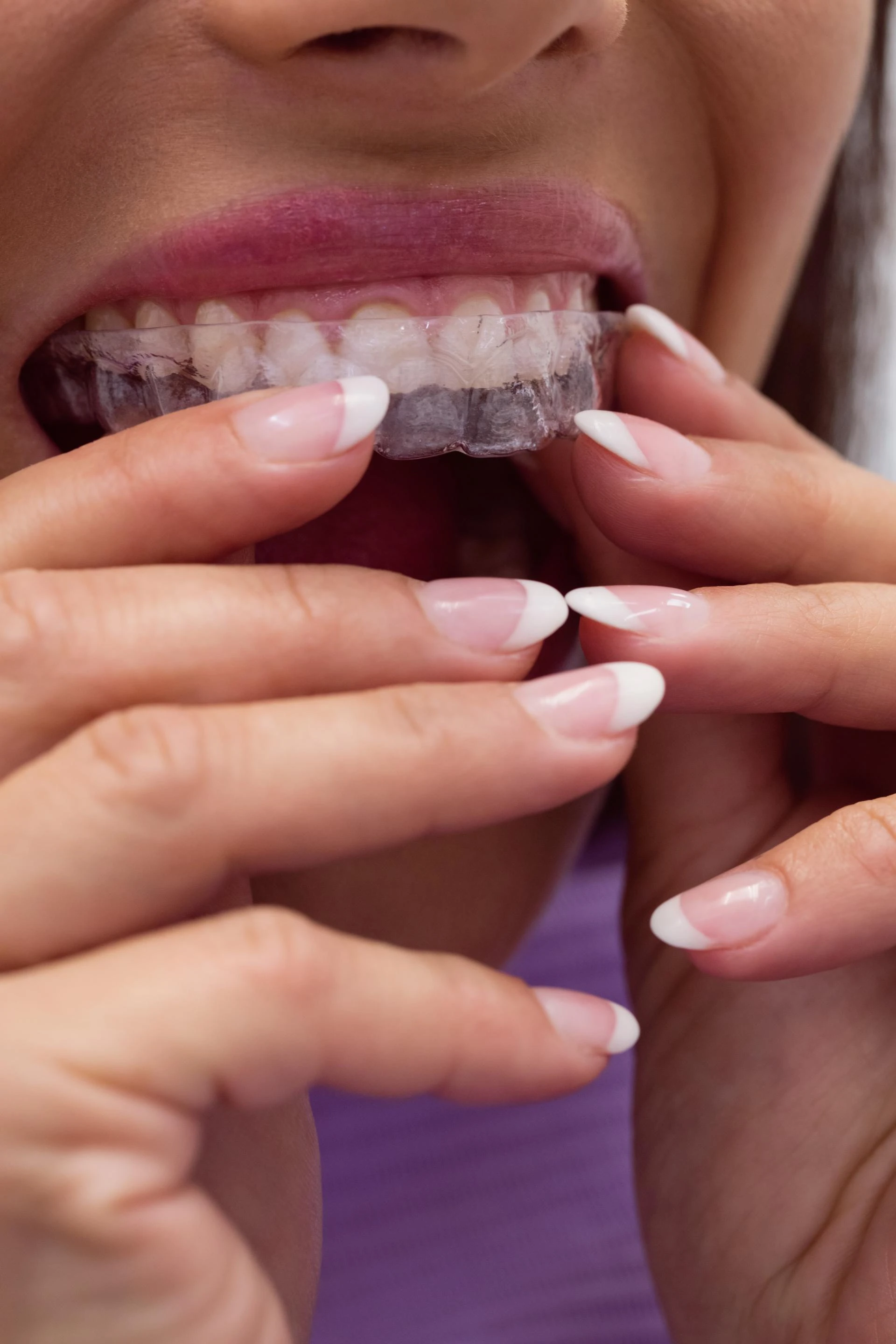 Get the Smile You’ve Always Wanted with Invisalign in Waterbury