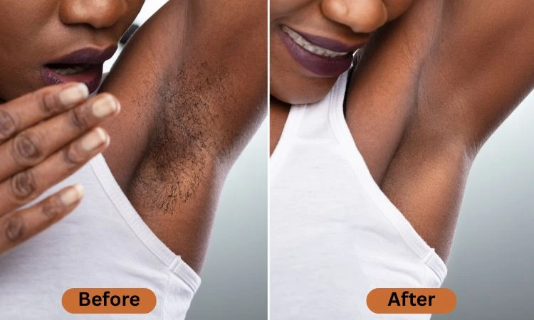 Laser Hair Removal Dermatologist NYC for Dark Skin: Expert Care for Smooth
