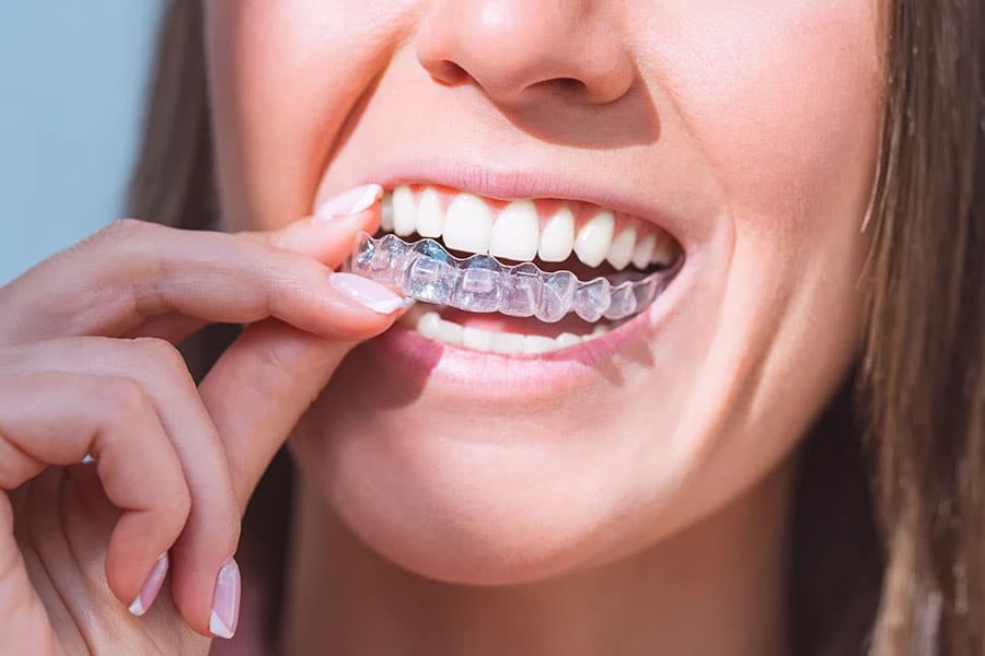 What Determines Candidacy For Orthodontic Aligners?