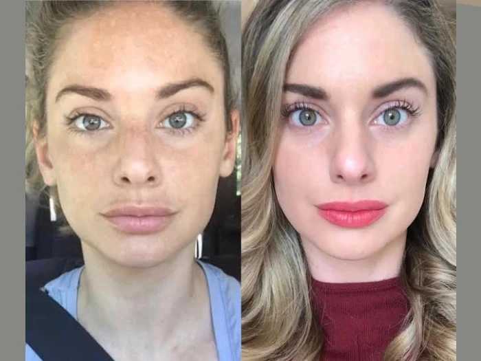 Youthful Glow with RF Microneedling by Best Plastic Surgeon in Dubai