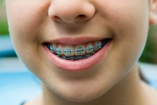 How to Choose Best Braces for Kids? | Step by Step Guide
