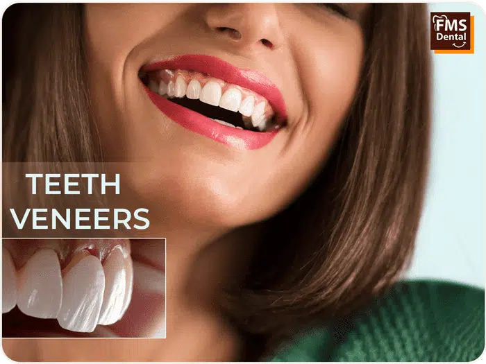 Emax Veneers Cost in Kondapur – FMS Dental Clinic in Kondapur