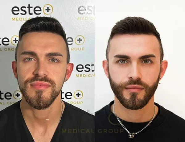 Beard Transplant in London for Long-Term Facial Hair Restoration