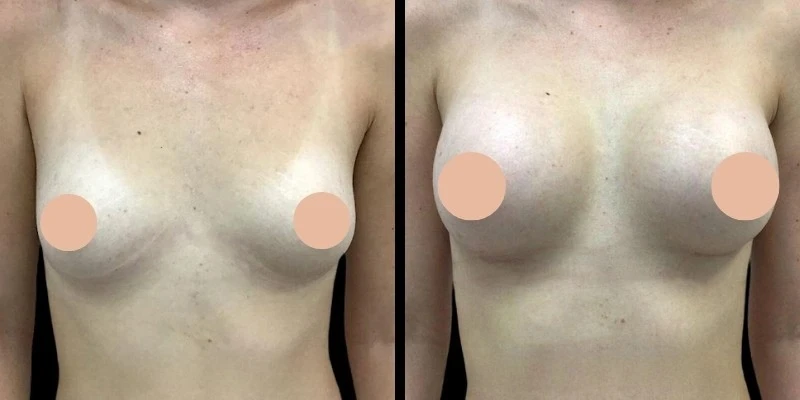 Breast Augmentation Surgery in Dubai: Understanding Costs and Financing Options