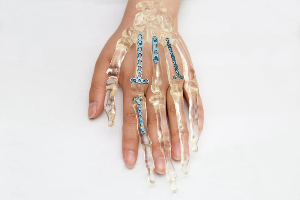 Understanding Orthopedic Implants: From Fracture Fixation to Joint Replacement