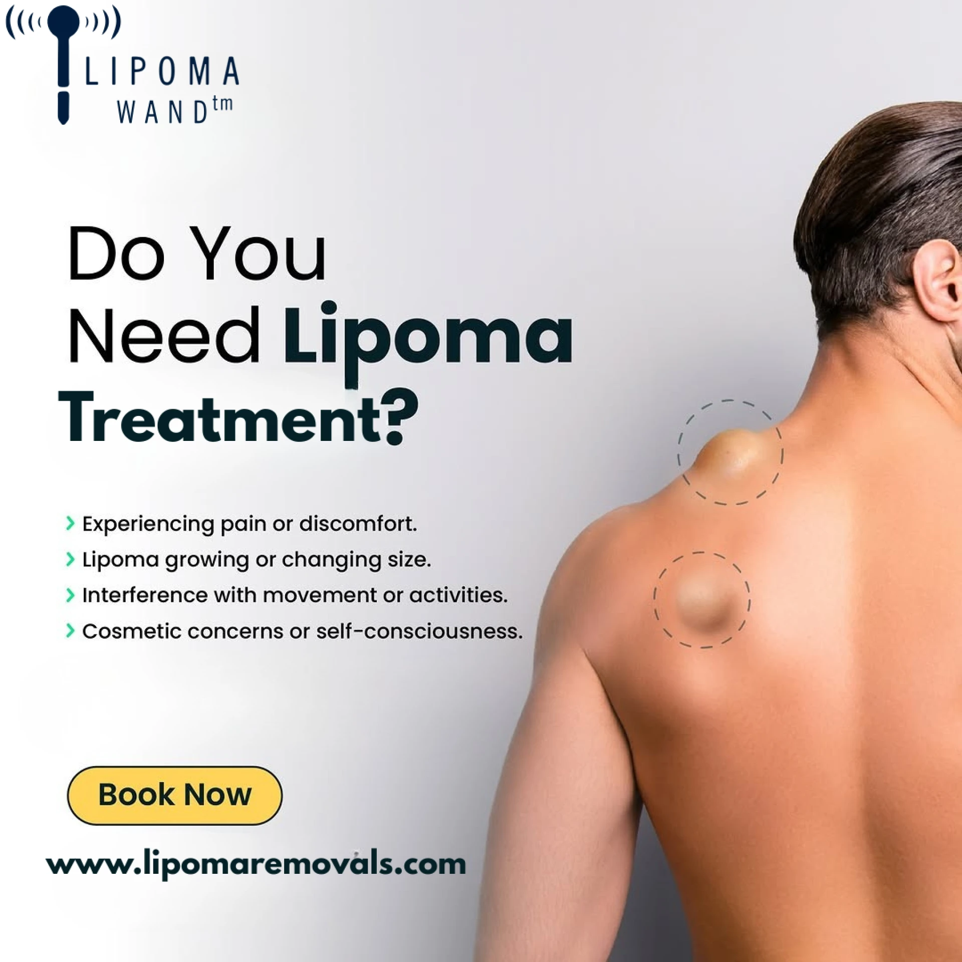 Non-Surgical Lipoma Care Made Simple