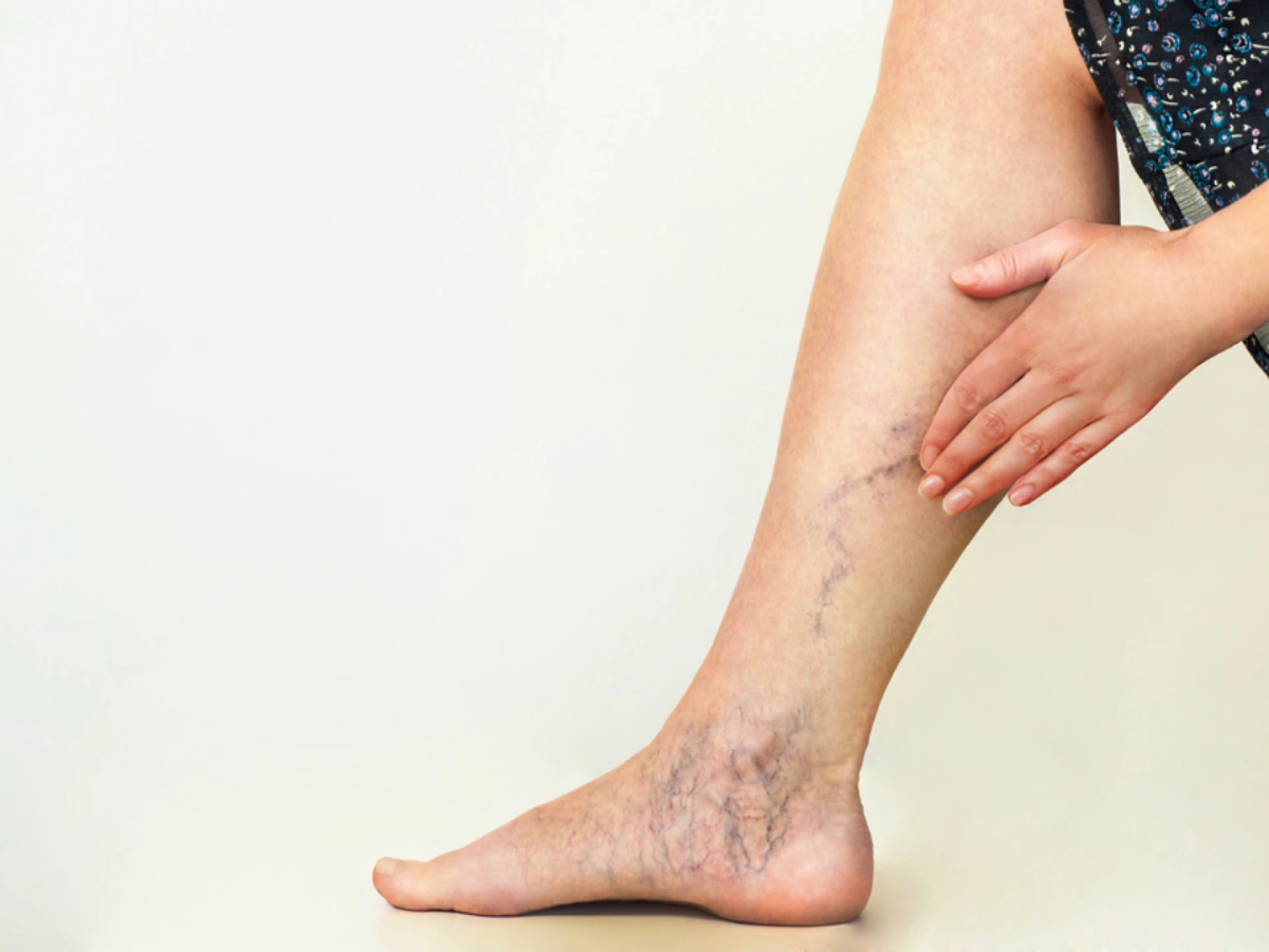 What Conditions Are Treated With Sclerotherapy?