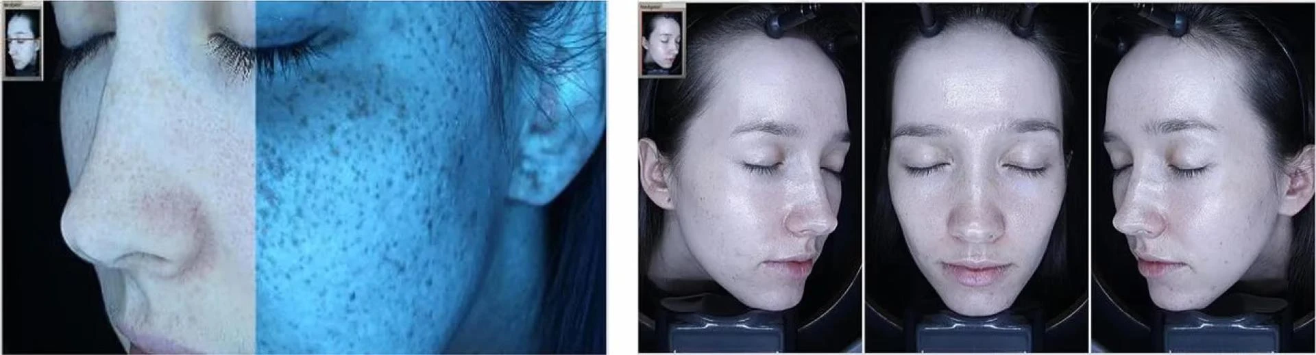 Overview of Digital Skin Analysis System: The tool that evaluates skin health