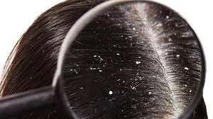 Best Anti Dandruff Shampoo for Healthy, Flake-Free Hair in the UAE