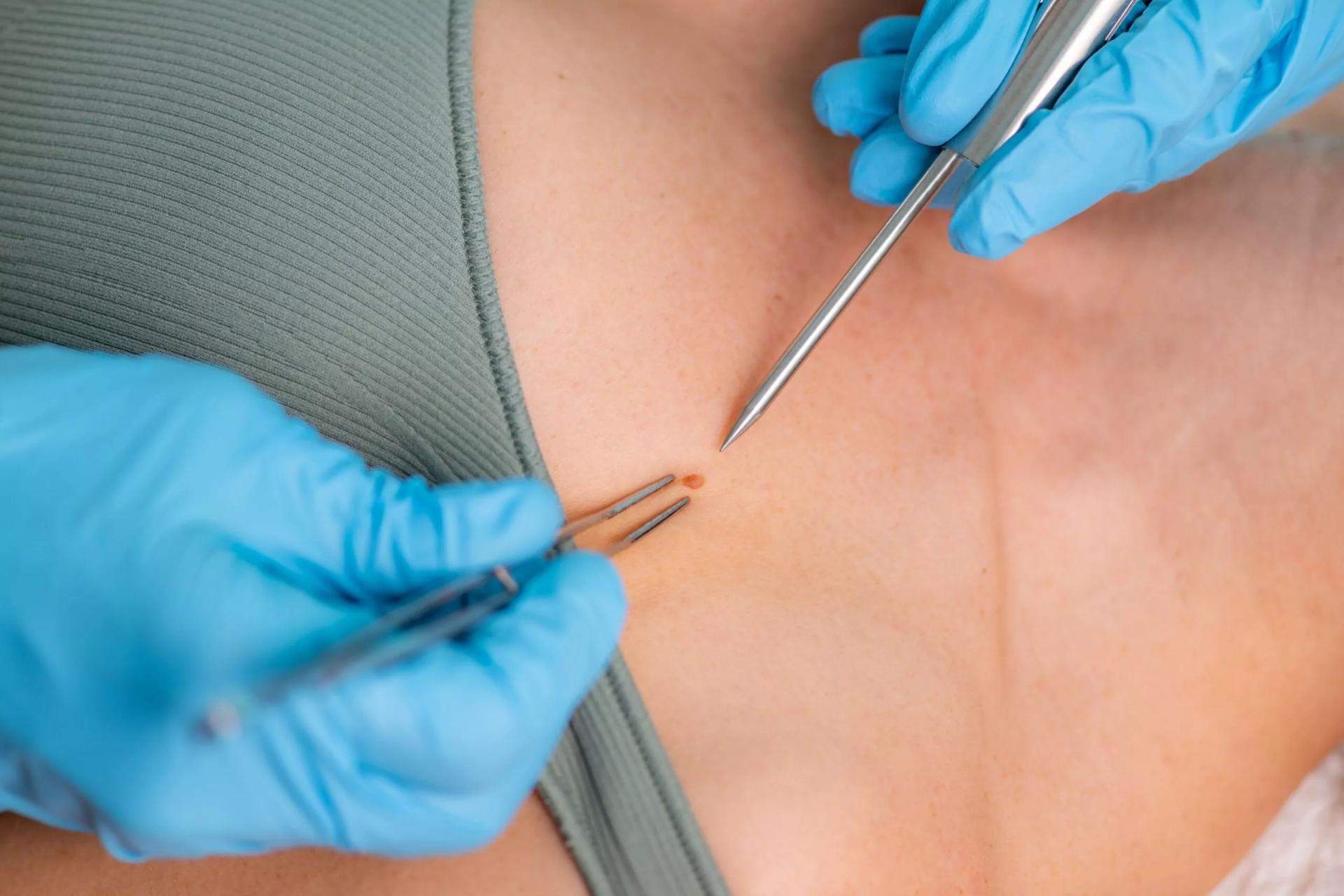 How Do Doctors Analyze A Biopsy For Diagnosis Purposes?