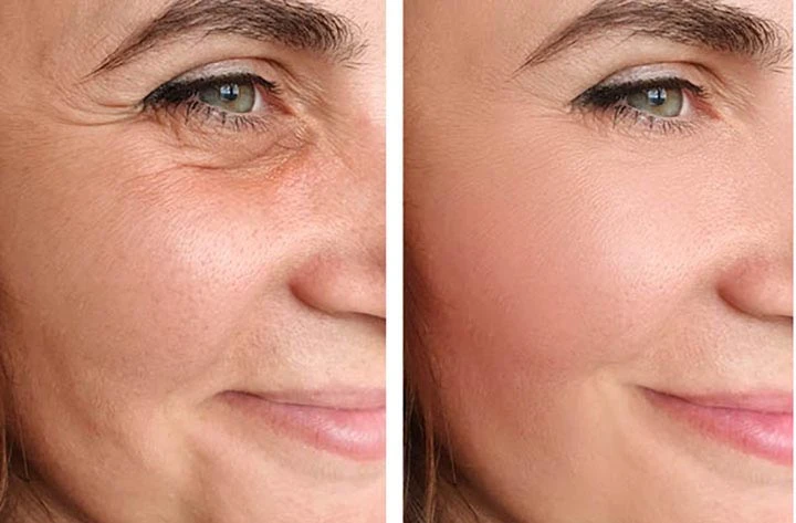How Long Does a Face Lift Last?