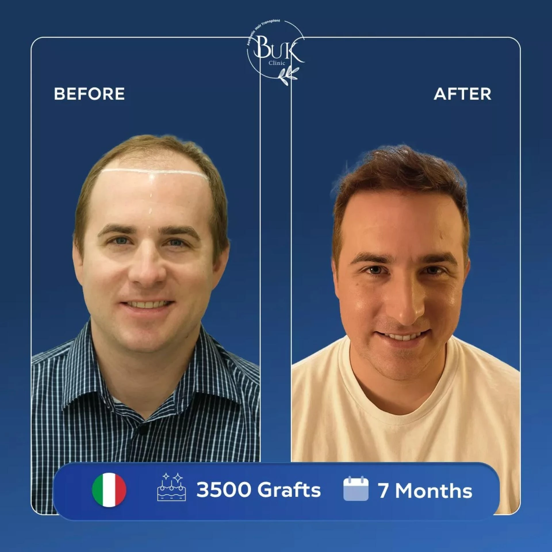 Why Choose Istanbul Over Other Countries for Hair Transplant