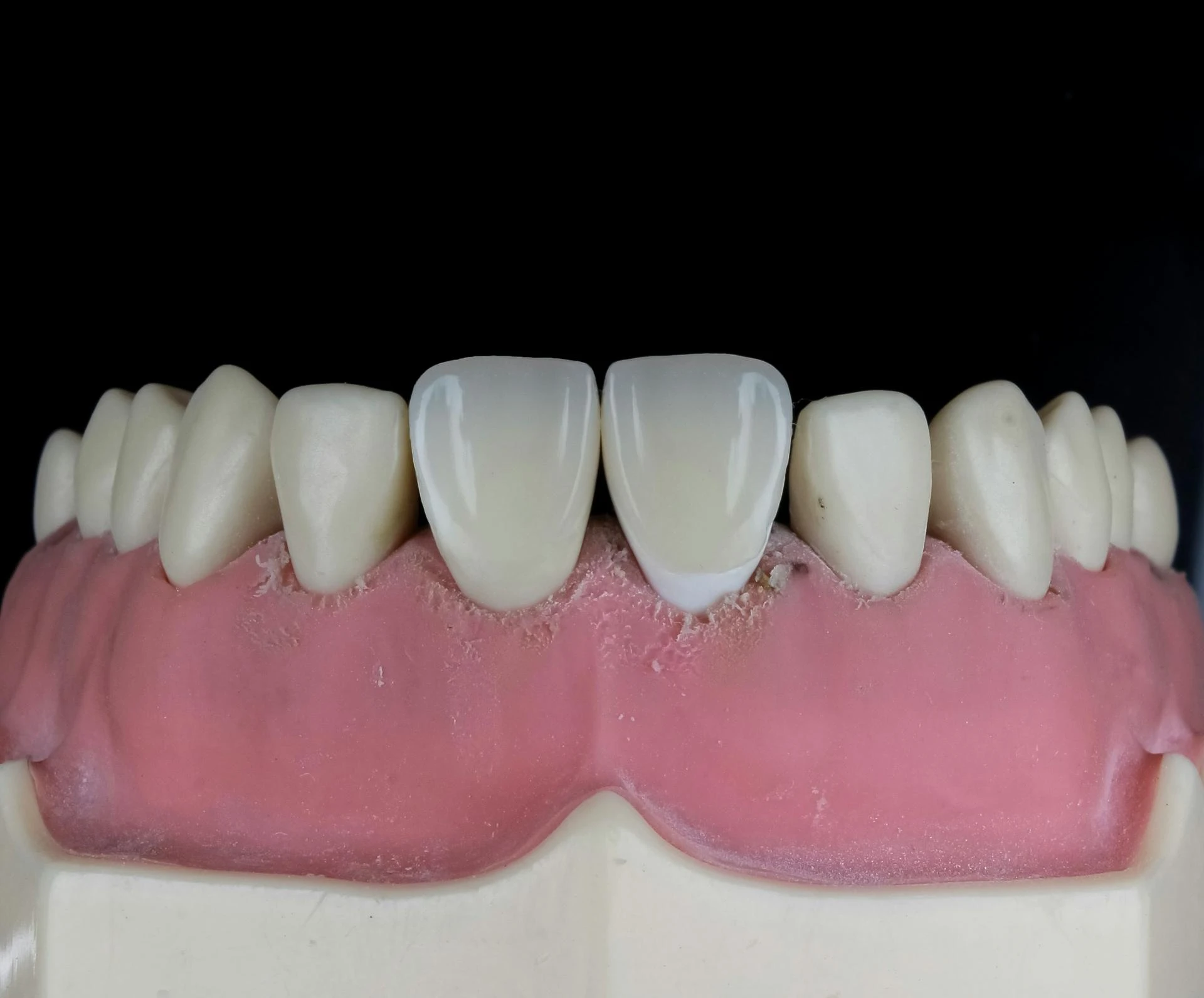 Clear Aligners in Magnolia, TX – Straighten Your Smile Comfortably