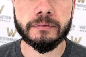 Real Patient Results: Beard Transplant London Before and After