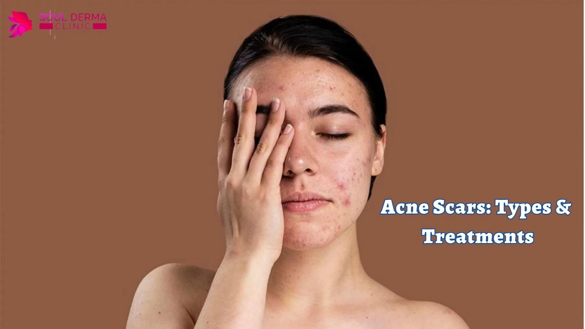 Acne Scars: Types &amp; Treatments
