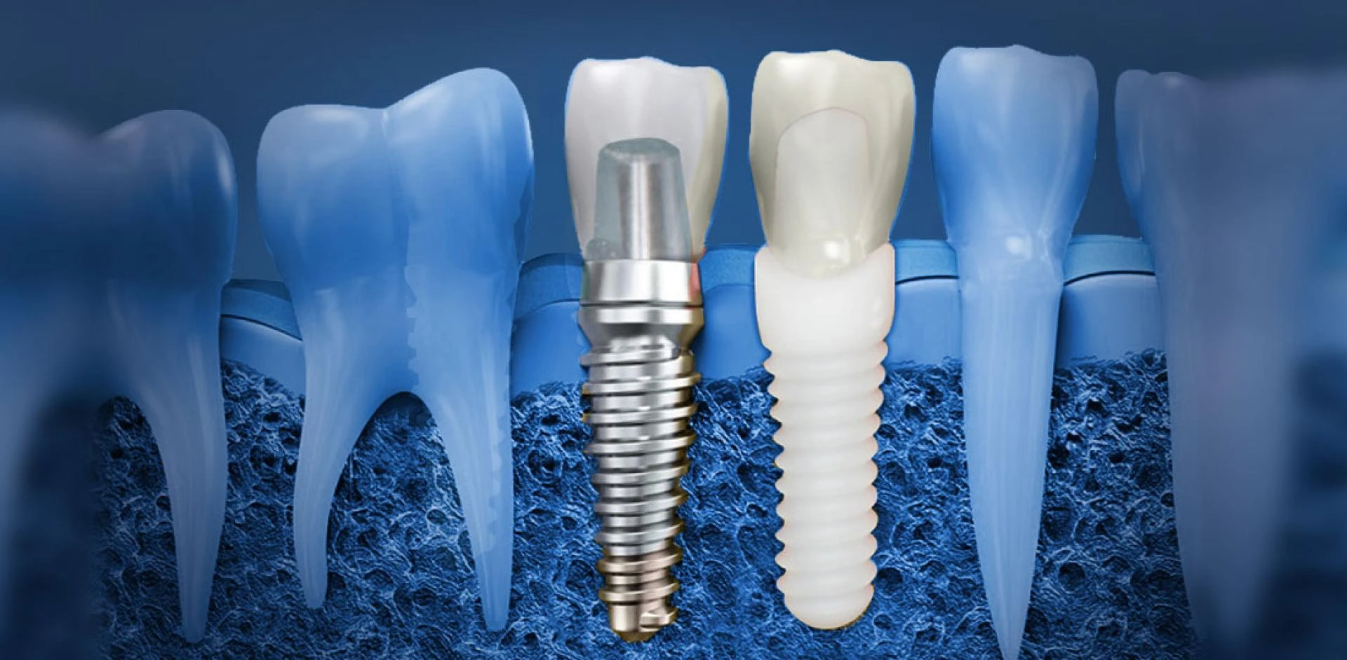 Is Dental Implant Treatment Good for You