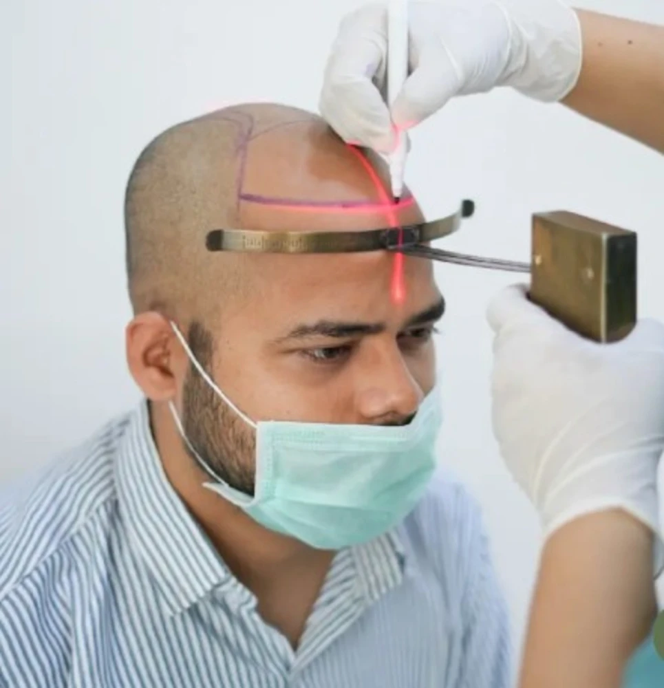 Hair Transplant Clinic in India: What You Should Know Before Choosing One