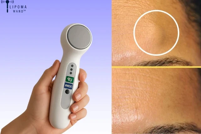 Lipoma Wand – The Smart and Safe Lipoma Treatment Without Surgery