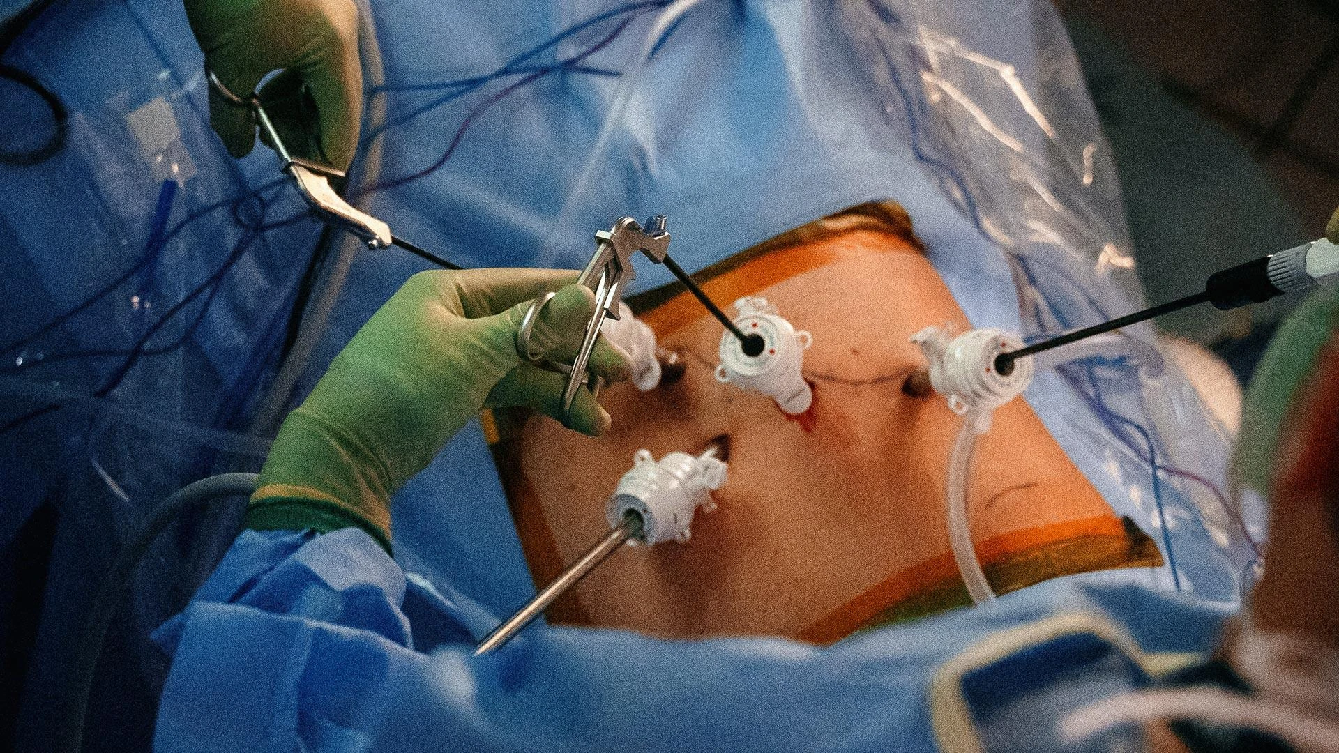 Recovery After Laparoscopic Adrenalectomy: What to Expect