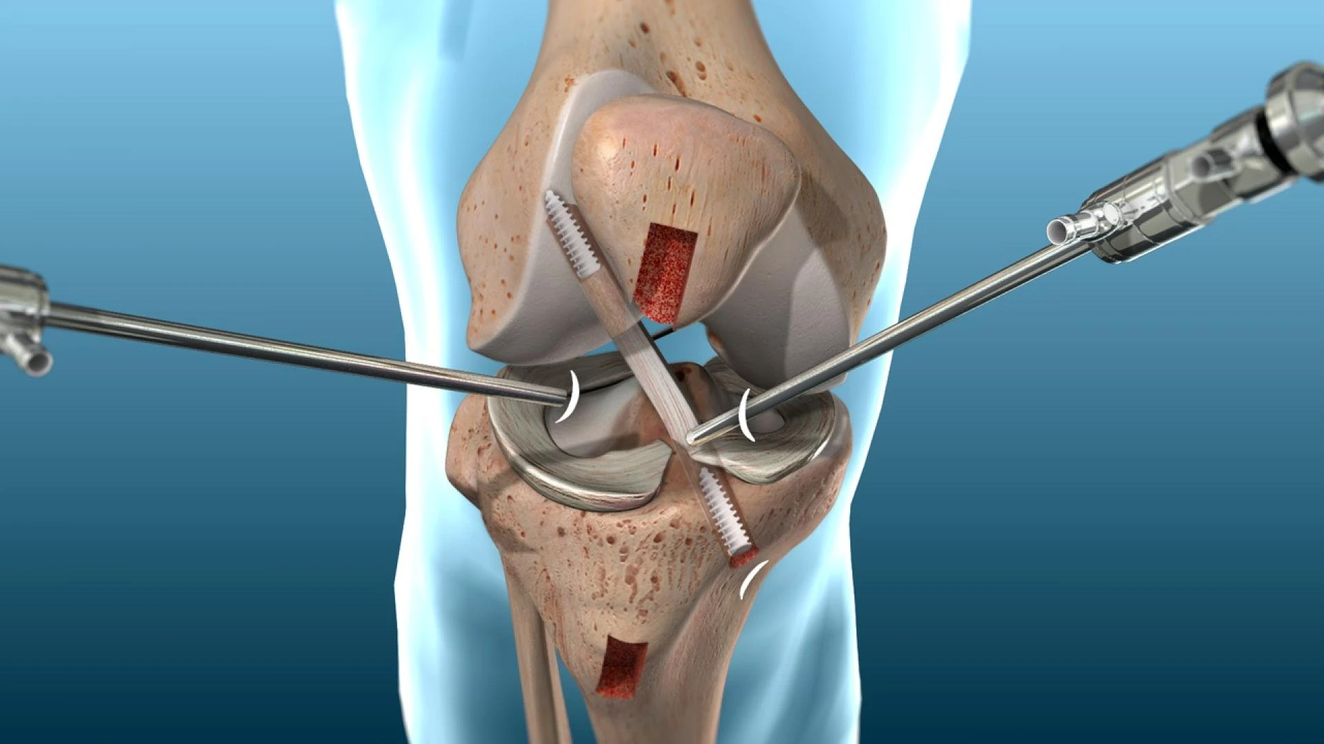 When Can I Walk After ACL Reconstruction Surgery?