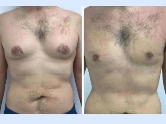 Gynecomastia in Dubai: Before and After Results and Expectations