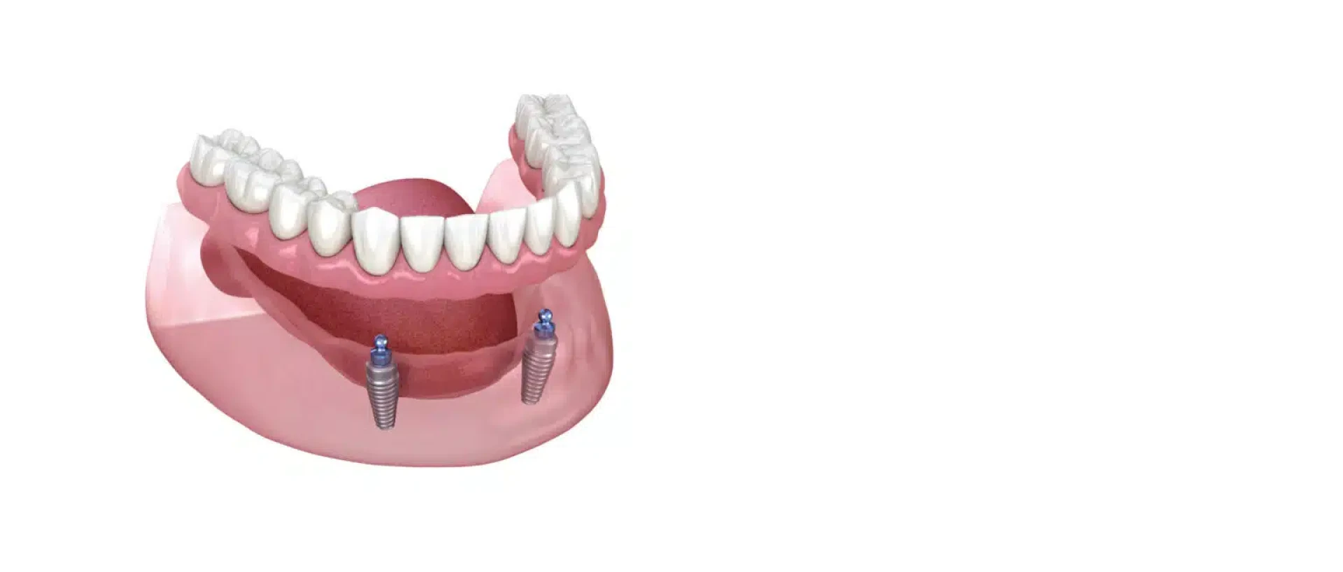 What Are Implant Supported Dentures and Are They Right for You?