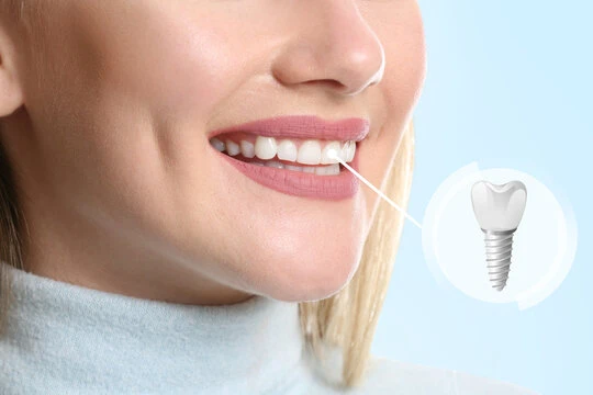 What Is the Full Mouth Dental Implant Cost in Hadapsar?