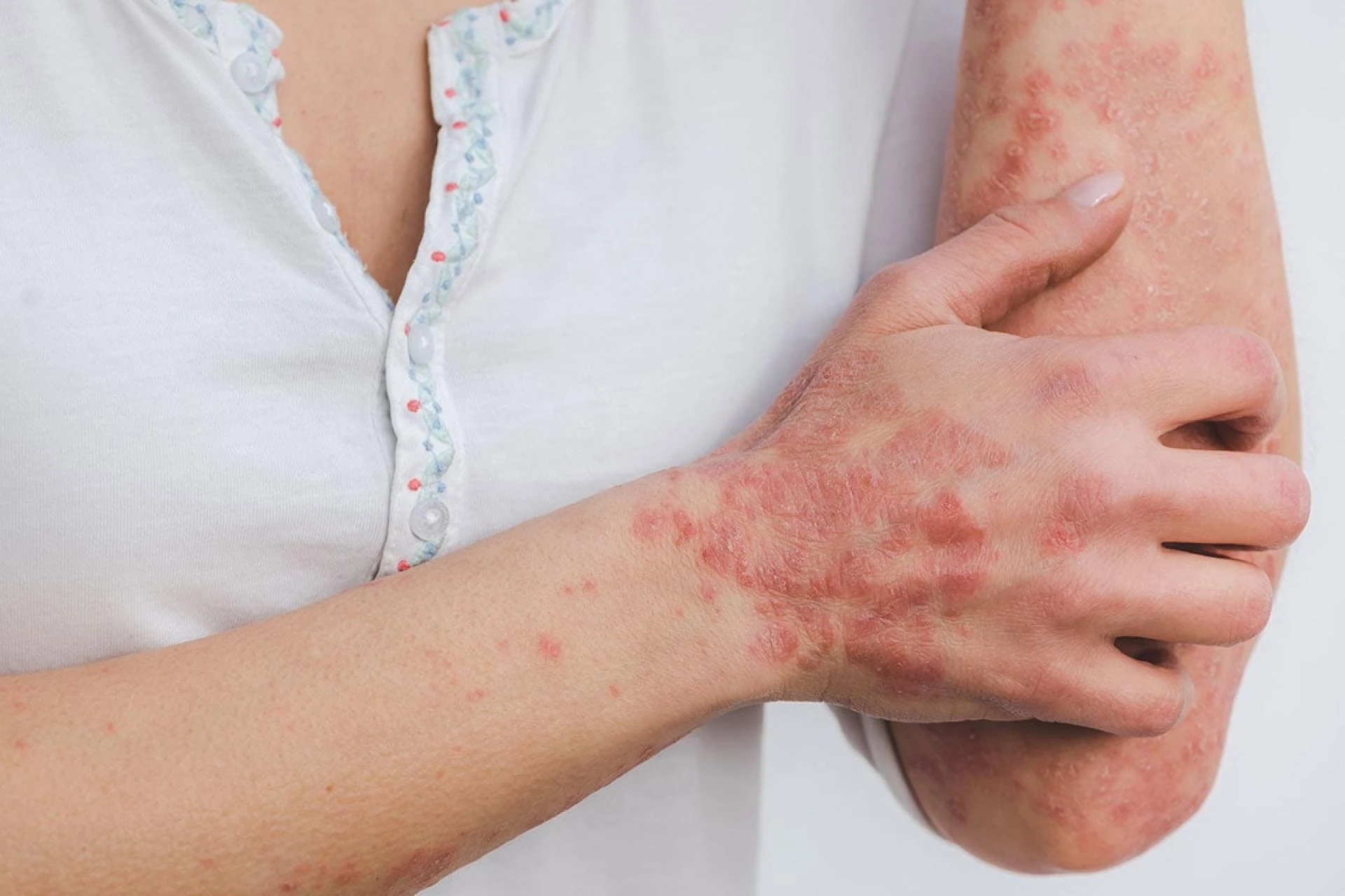 Top 5 Medical Approaches Used in Best Psoriasis Treatment Plans