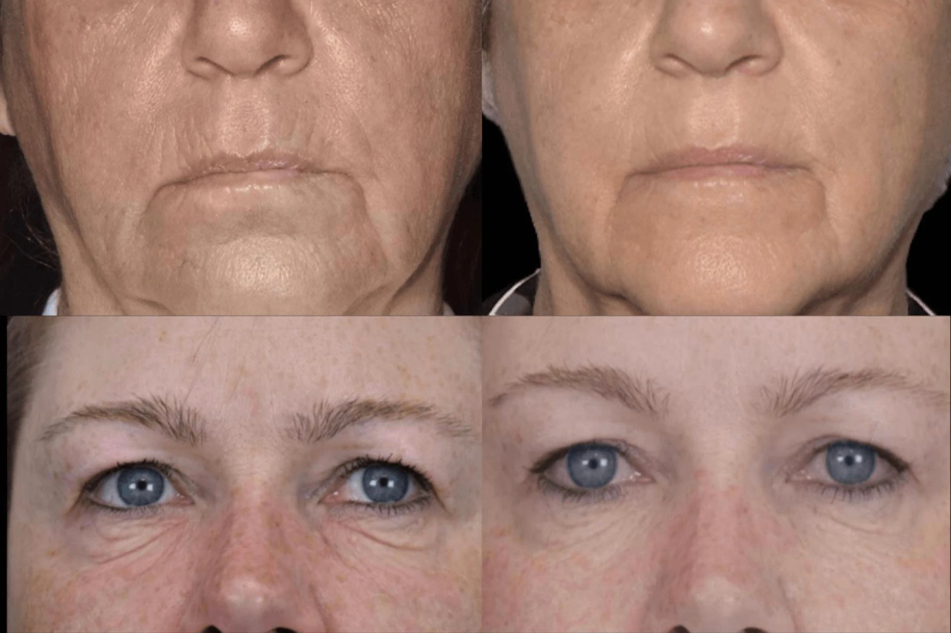 Exion Facial Rejuvenation Treatment Benefits and Results