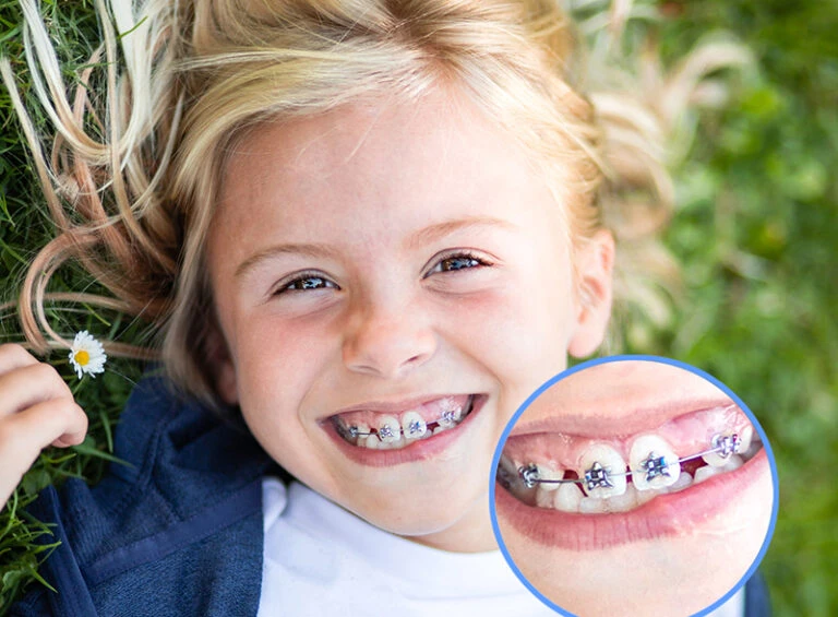 Ultimate Braces Care Tips For School-going Children