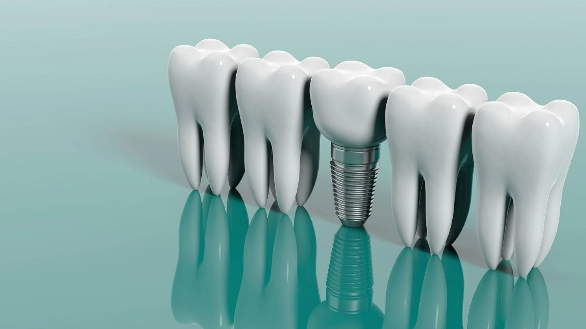 Dental Implants Treatment: Types, Cost, Procedure, Benefits