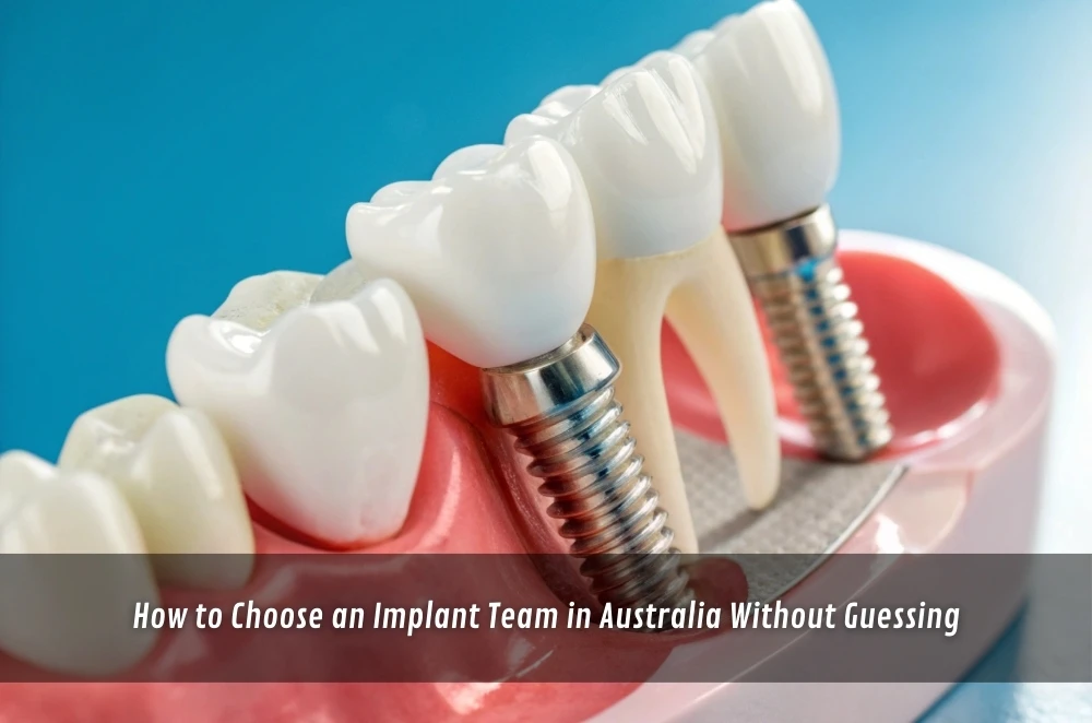 How to Choose an Implant Team in Australia Without Guessing
