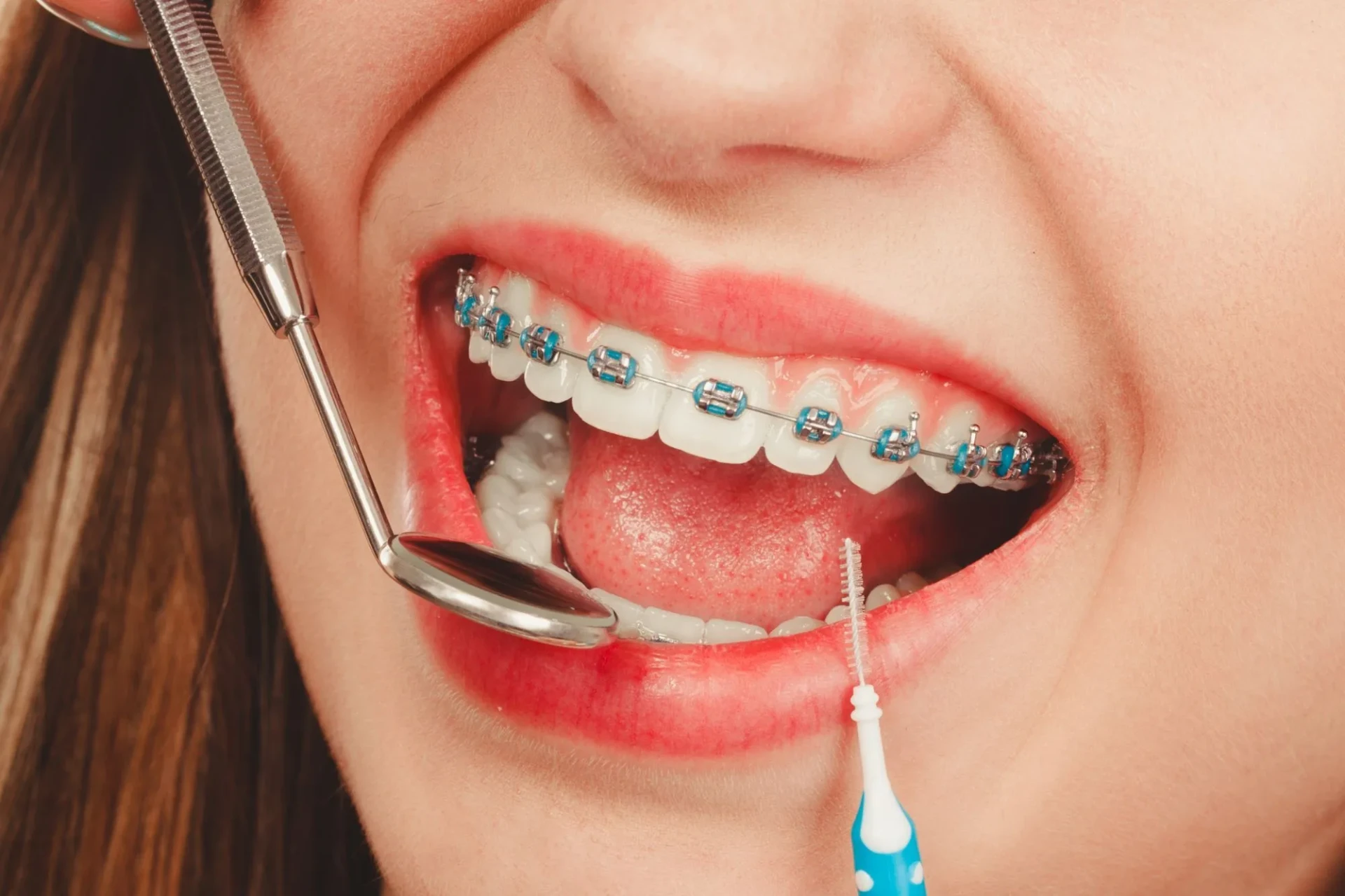 Straighten Your Smile: Why Braces Are Still the Best Choice