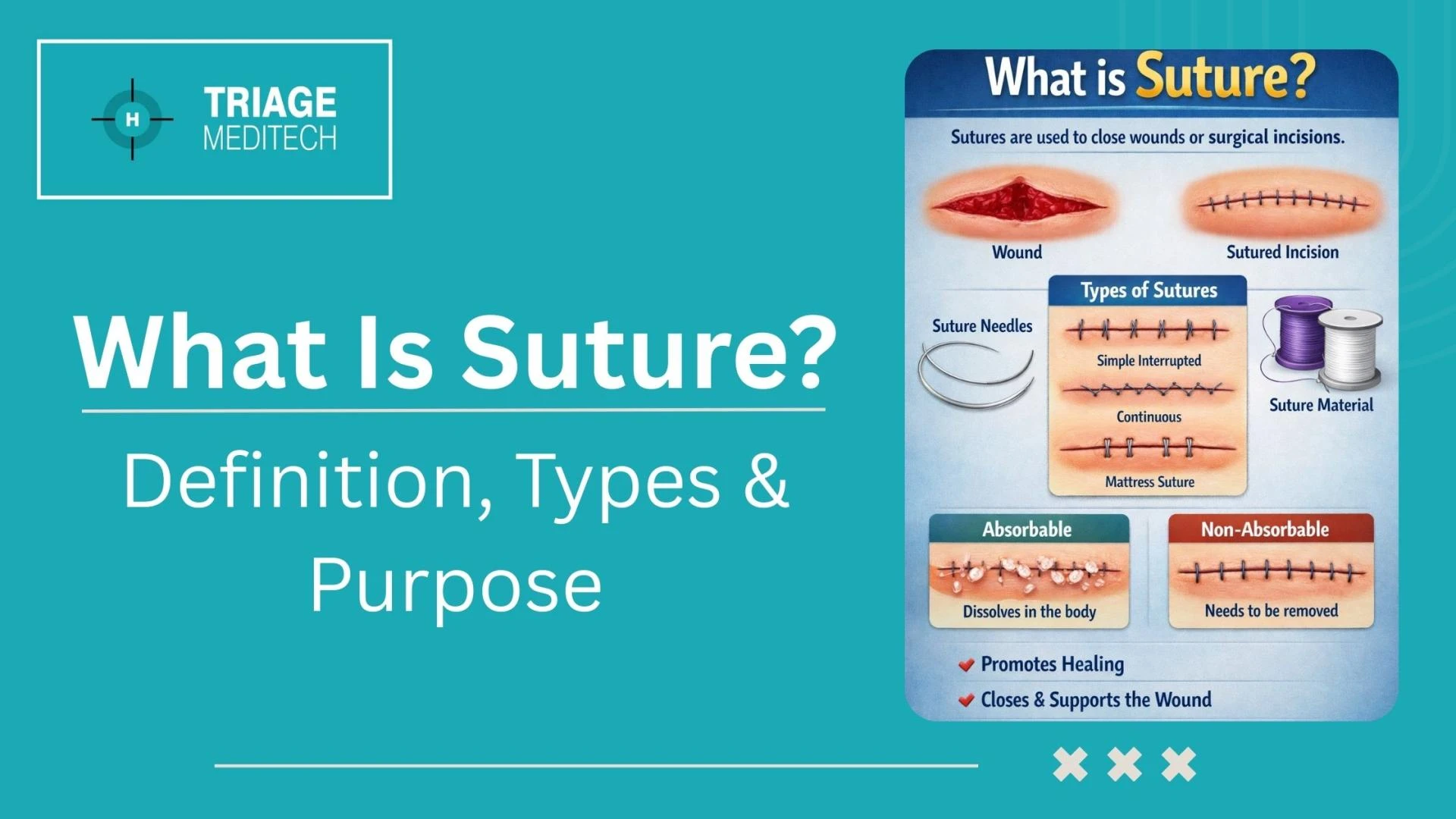 Type of Suture: A Complete Clinical Guide to Suture Materials and Techniques