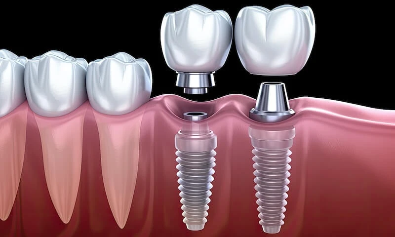 The Best Ways To Find Affordable Dental Implants!