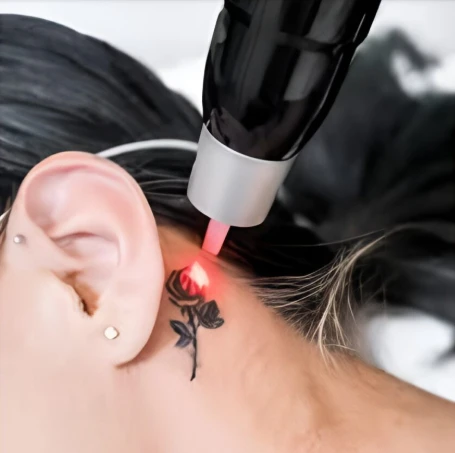 Laser Tattoo Removal in Windham, NH: What Local Clients Should Know Before Getting Started