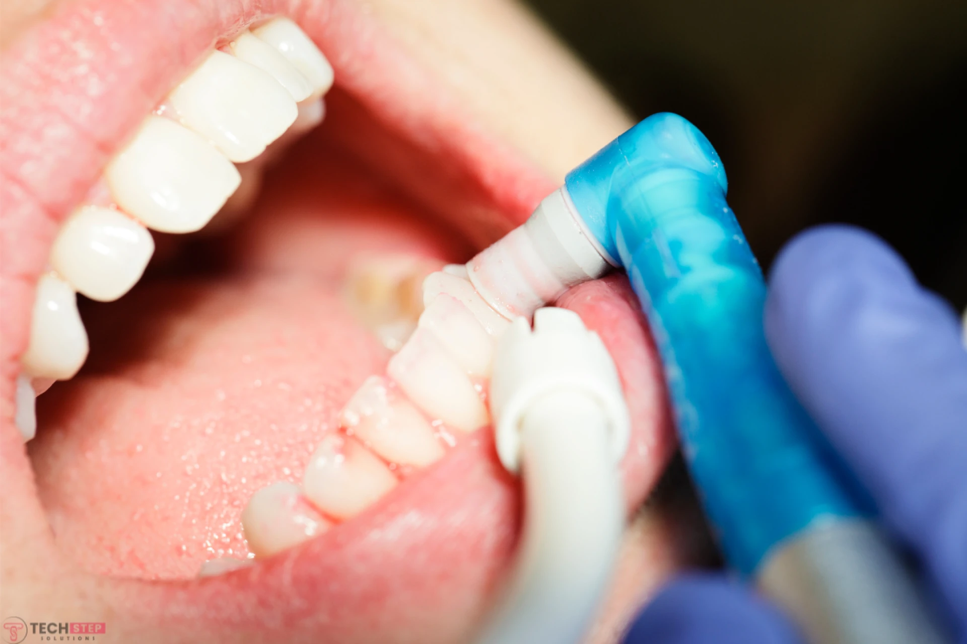 Dental Bonding vs Veneers: A Complete Guide to Choosing the Right Smile Upgrade