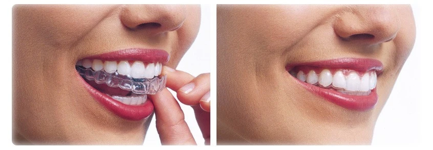 Everything You Need to Know Before Starting Invisalign Treatment