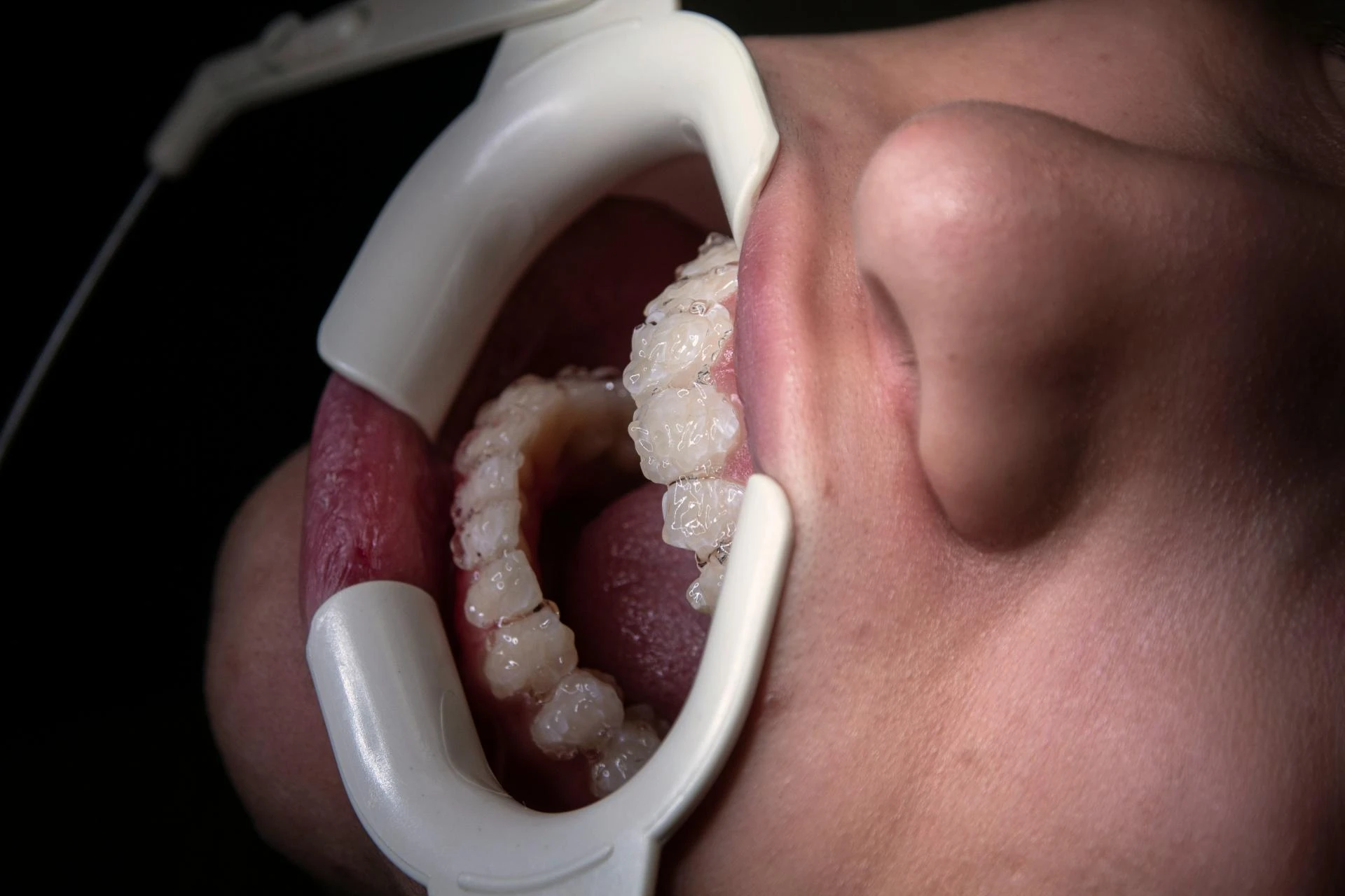 Teeth Whitening for Kids: Is It Safe and Effective?