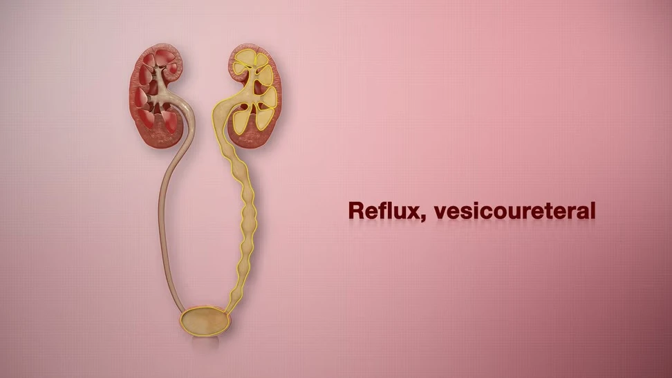 Vesicoureteral Reflux Surgery Child in Delhi - Advanced Pediatric Urology Care