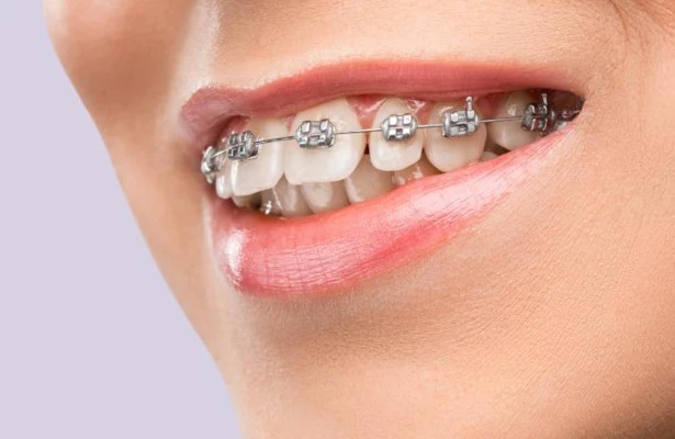 Best Braces Treatment in Nagpur: A Complete Patient Guide