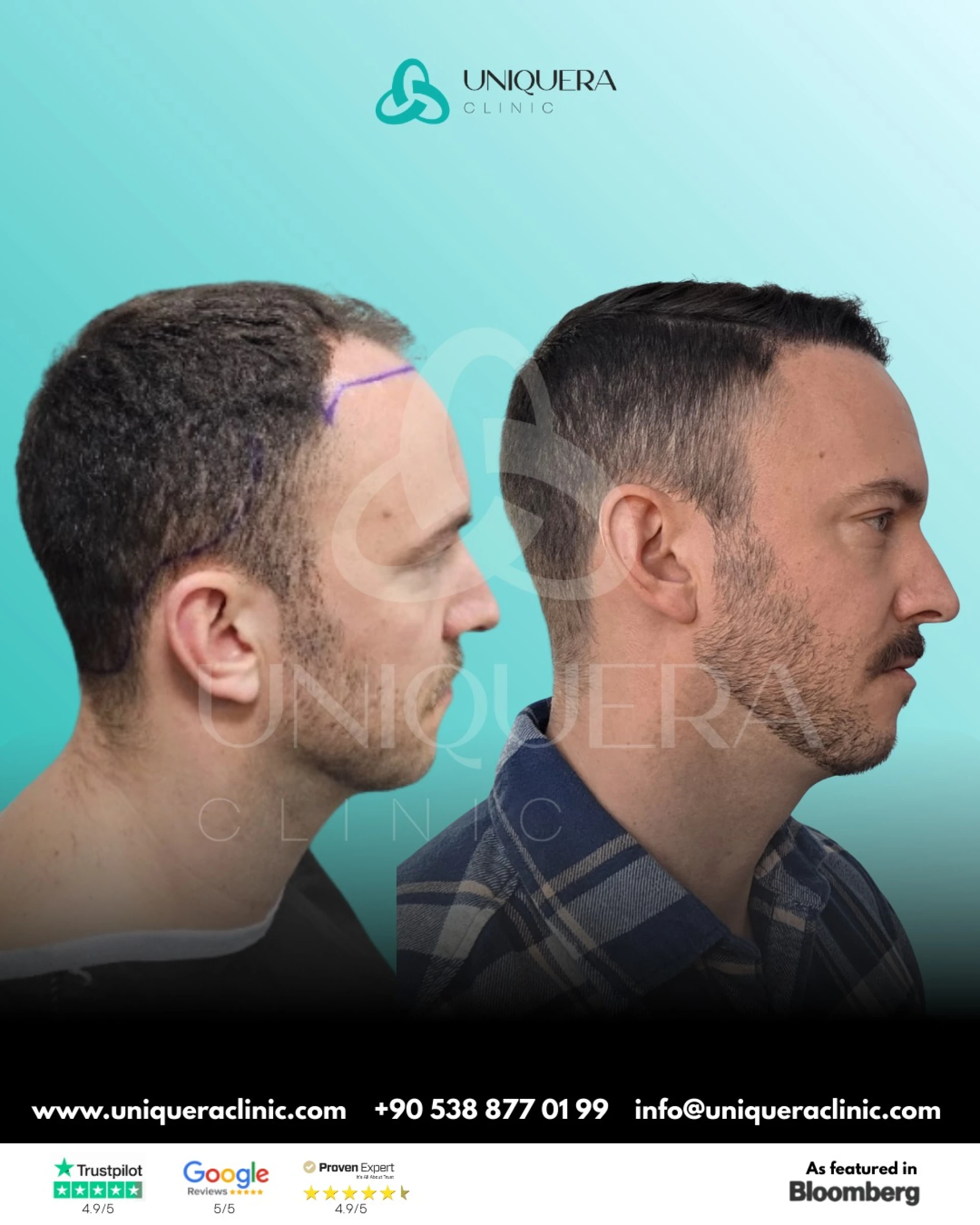 How to Know If You’re Eligible for Hair Transplant Surgery