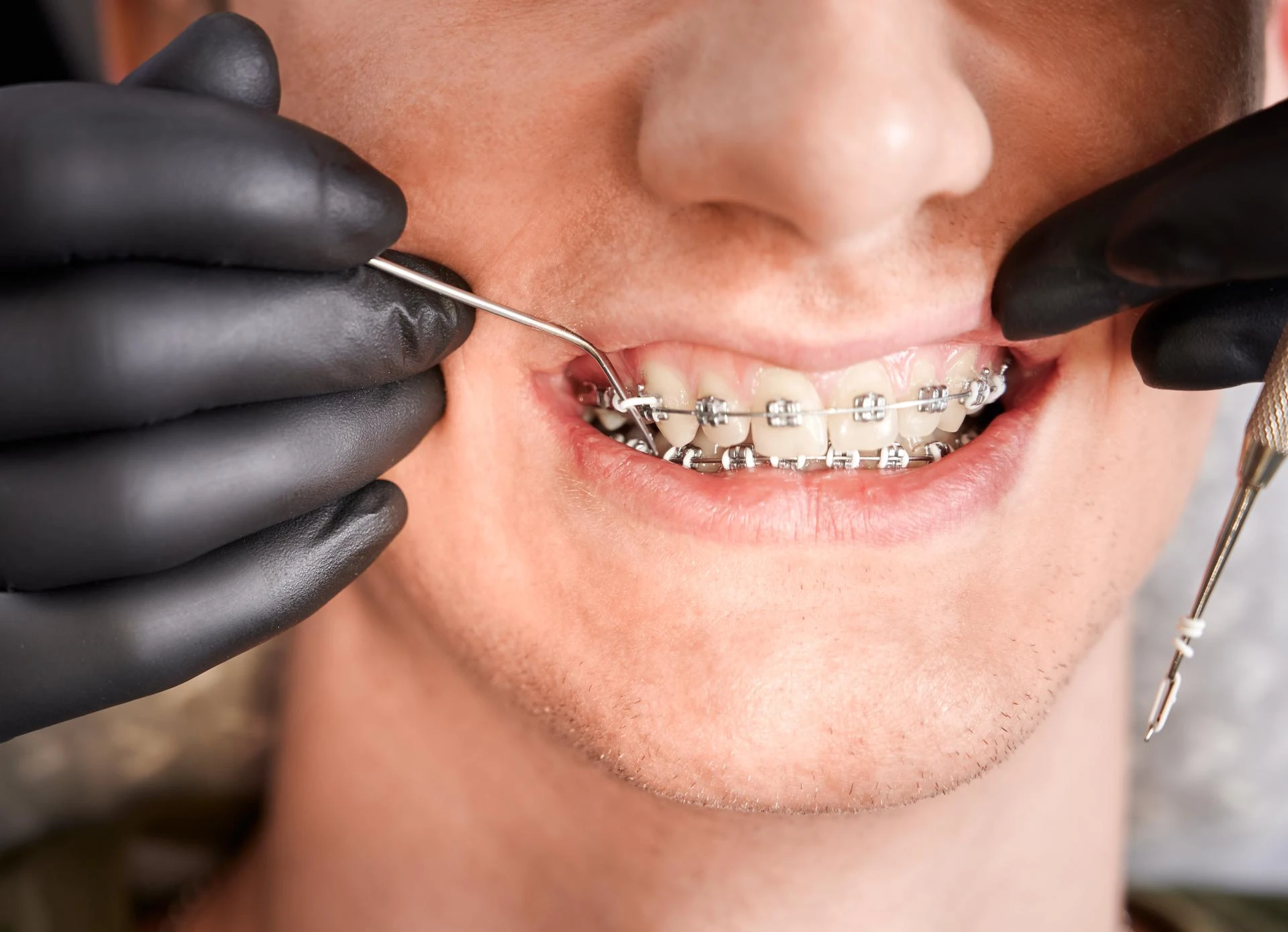 Trusted Orthodontist for Braces in Smyrna – Book Your Consultation Today