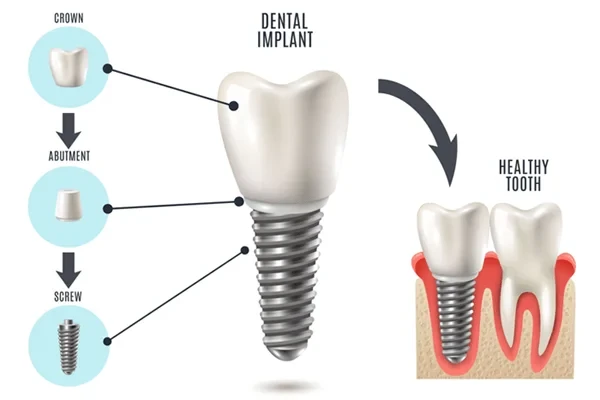 How Dental Implants Improve Oral Health and Jawbone Strength