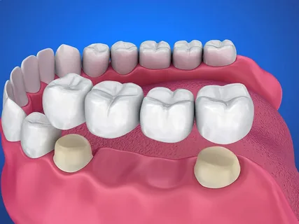 Dental Crown & Bridge Treatments: Restoring Strength and Confidence to Your Smile