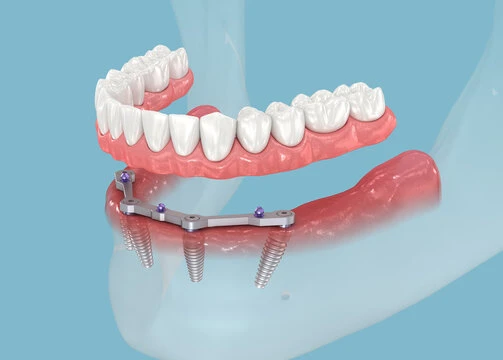 What Should You Expect During All-on-4 Dental Implant Treatment in Ravet?