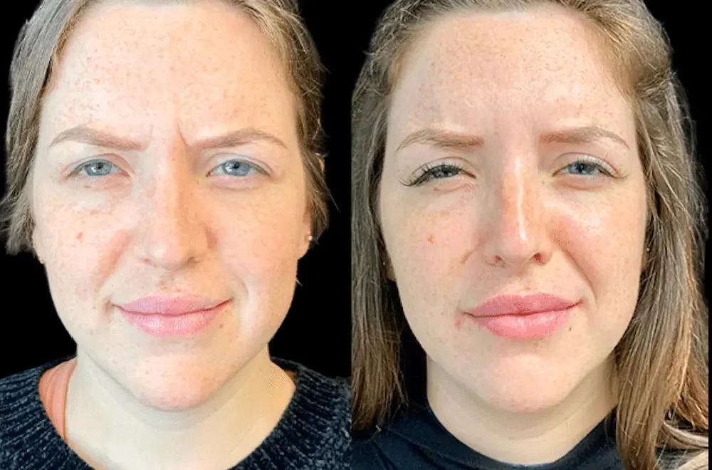 Botox Treatment in Dubai for Wrinkle Reduction: Complete Guide